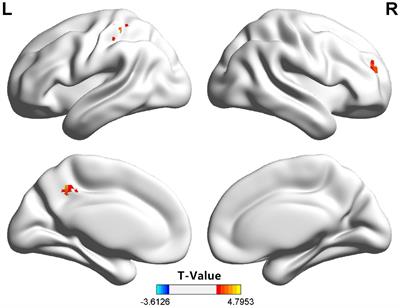 Dynamic Functional Connectivity Reveals Abnormal Variability in the Amygdala Subregions of Children With Attention-Deficit/Hyperactivity Disorder